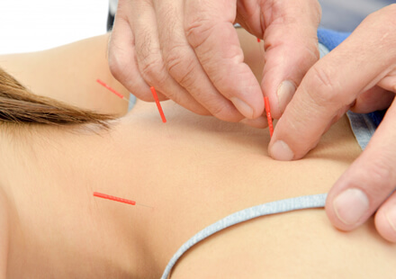 鍼灸